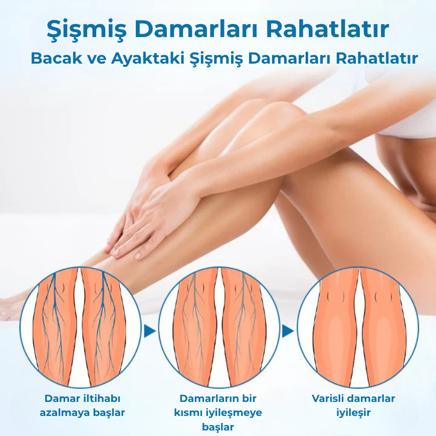 Timilk® VeinGuard Bitkisel Sprey – Sadece 14 günde varisleri ortadan kaldırdığı klinik olarak kanıtlanmıştır!