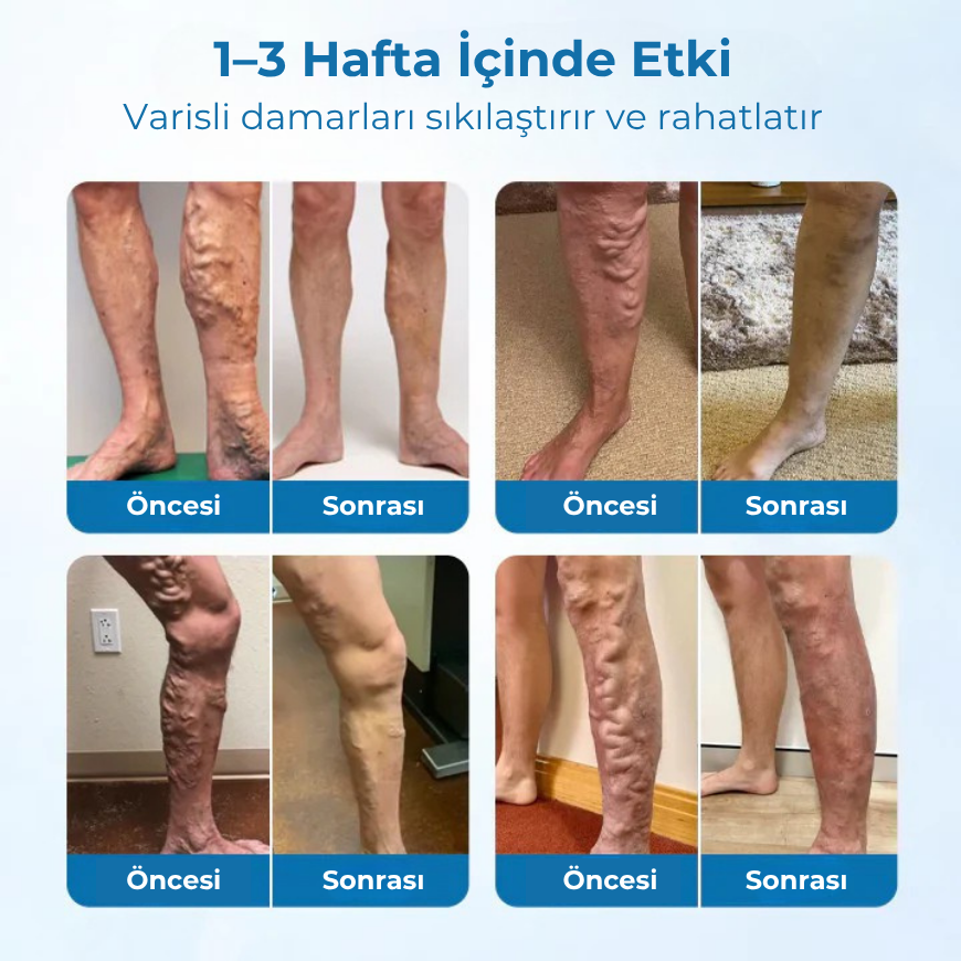Timilk® VeinGuard Bitkisel Sprey – Sadece 14 günde varisleri ortadan kaldırdığı klinik olarak kanıtlanmıştır!